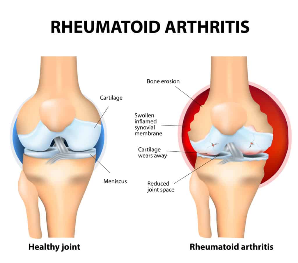 Rheumatoid Arthritis (RA) is an inflammatory type of arthritis that usually affects knees. Rheumatoid arthritis of the knee the auto immune disease. The body's immune system mistakenly attacks healthy tissue.