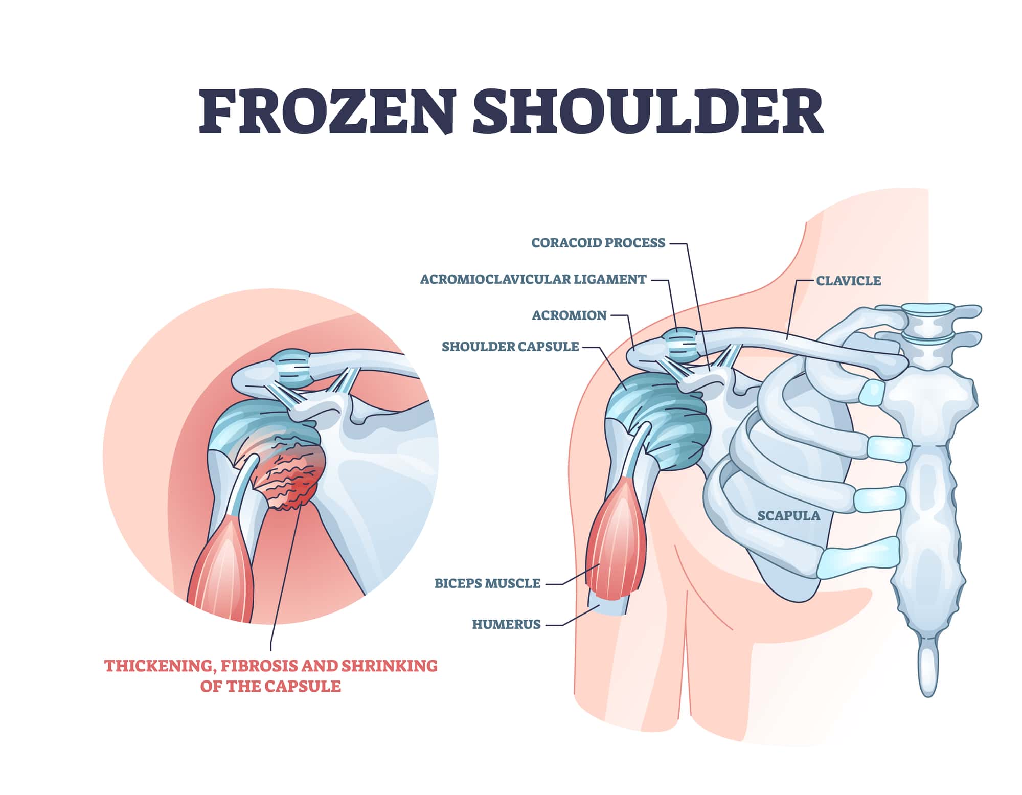 Frozen shoulder condition or adhesive capsulitis syndrome outline diagram. Labeled educational medical diagnosis with pain and stiffness around body upper part with movement limits vector illustration